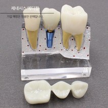 치아 모형 치과 교육용 병원 치석 이빨 임플란트 구강 입모형 재료상, B. 투명