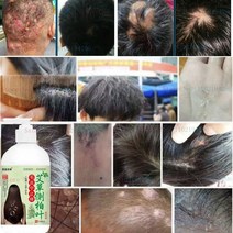 두피 에센스 영양제 두피 모낭염 완화 비듬 가려움증 오일 컨트롤 진드기 제거 출혈 붓기 샴푸 500ml, 02 2 bottle