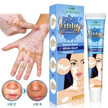 BT 백반증 치료 연고 손 목 몸 얼굴 연피부 백반증치료, 20g, 3개