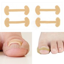 일상생활가능한 내성발톱테이프 무지외반증 내성발톱교정