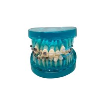 누렁니 미백 dental orthodontic tooth model with braces archwire 잇몸 수지 재료 학습 교육 환자 교육, 푸른