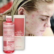 수분부족지성 좁쌀여드름토너 수부지 기초 닦는 속건조 토너 중학생 여드름 화장품