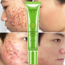 스킨케어 바디케어 효과적인 여드름 제거 크림 치료 여드름 흉터 반점 오일 컨트롤 수축 모공 미백 보습 안티 여드름 페이스