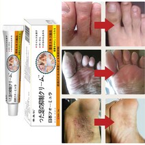 BT 무좀약 연고 발톱무좀 치료 발가락 가려움 연고 발냄새 제거, 5개, 20ml