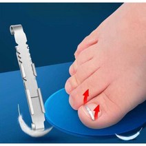 자리관리 교정 팁 내성발톱 엄지발가락 자가, (프론트 아머 버클 1팩) 강화 버전