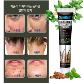 가려움증 두피 모낭염 연고 20g S-16, 2개, 20ml