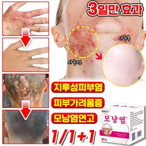 1/1+1 [즉효] 모낭염 연고 지루성피부염 피부가려움증 여드름 완화 크림, 3개, 30g