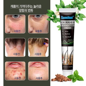 가려움증 두피 모낭염 연고 20g S-16