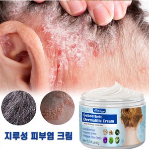 두피 지루성피부염 효과적인 치료 천연허브안전무자극, 1개, 50ml