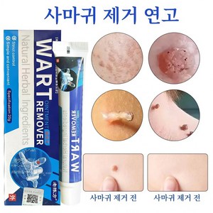 [국내배송]사마귀 피부 치료/강력한 사마귀 제거/일주일의 이별/편평사마귀/얼굴 사마귀/닭의 눈/좁쌀알/증세W033, 1개, 20g