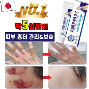 일본기술 1/1+1 화상 연고 흉터 상처 제거 재생 크림 피부 관리 케어, 1개, 25g