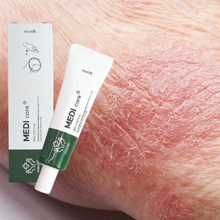 기니디샵 건성 피부 진정 크림 건선 가려움증 진물