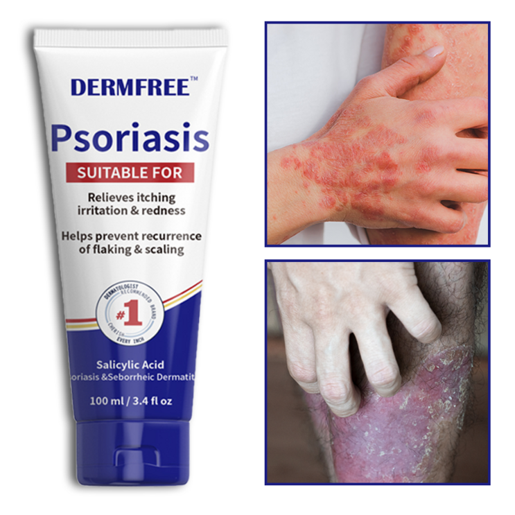 DERMFREE 건선 크림 습진 두드러기 피부염 두피건선 피부 가려움증